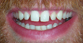 anterior_crowns_before