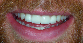 anterior_crowns_after