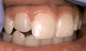 anterior_composite_after