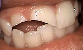 anterior_composite_before