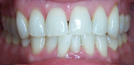 bleaching_after