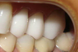 Cerec_After_1
