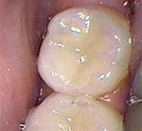 fillings_after