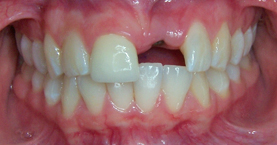 implant_before