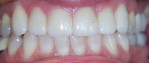 Veneers_After_1