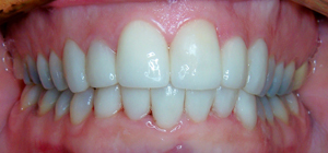 Veneers_After_2