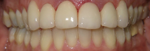 Veneers_After_3